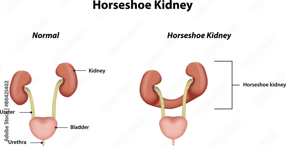 Horseshoe Kidney Labeled Diagram Stock Illustration Adobe Stock