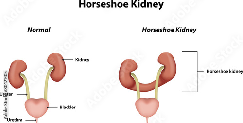 Horseshoe Kidney
