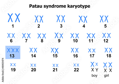Patau syndrome photo