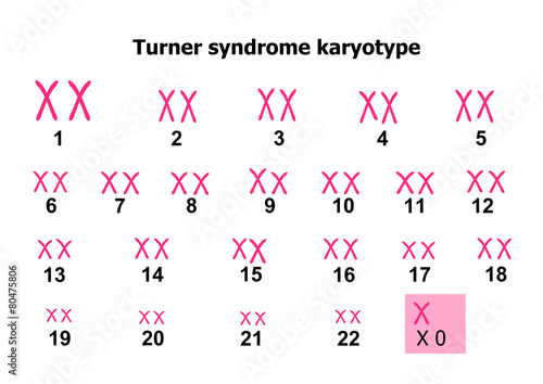 Turner syndrome karyotype