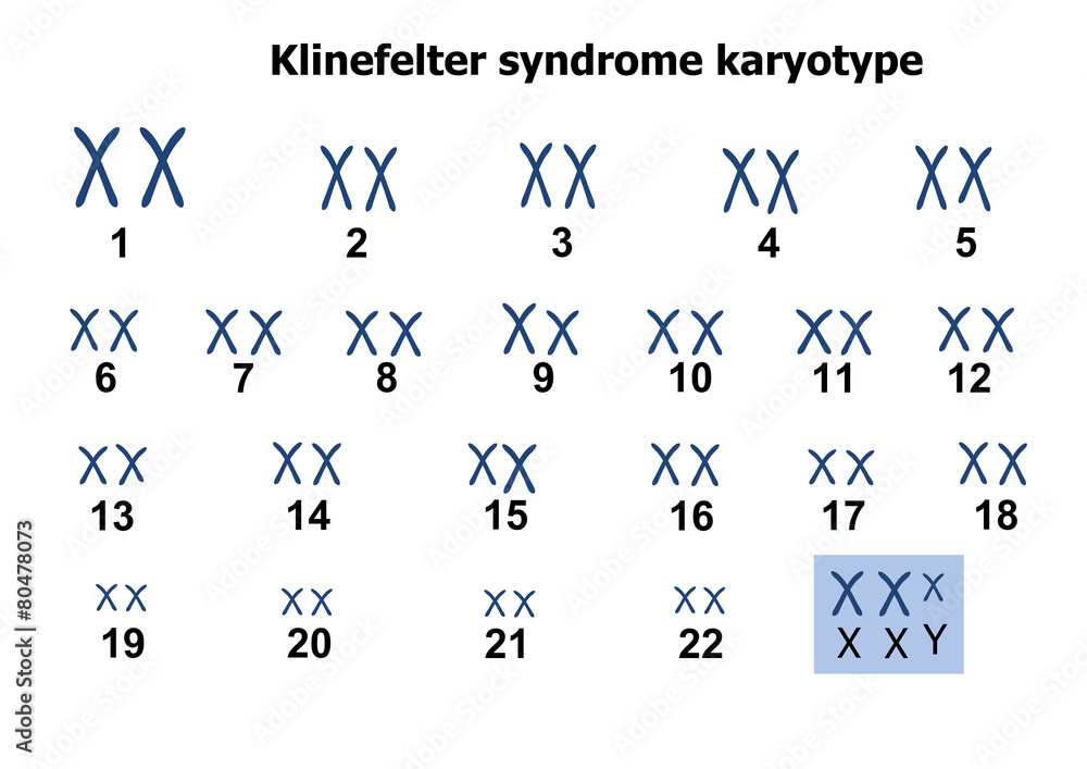 Klinefelter Karyotype Hot Sex Picture