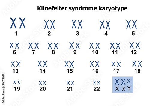 Klinefelter syndrome karyotype