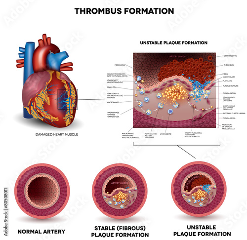 Blood clot formation. Anatomy of Healthy artery, unhealthy arter