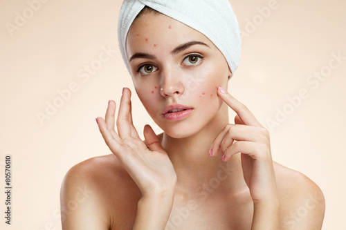 photos of ugly problem skin girl on beige background