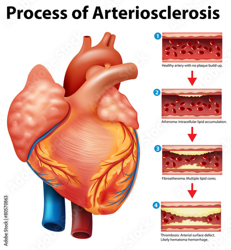 Process of Arteriosclerosis