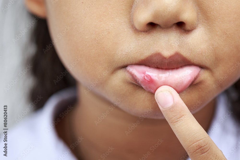 Fototapeta premium Children with aphtha on lip