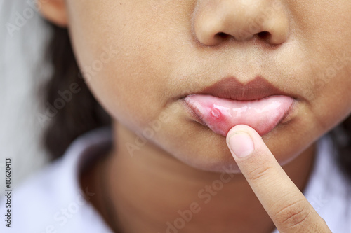 Children with aphtha on lip photo