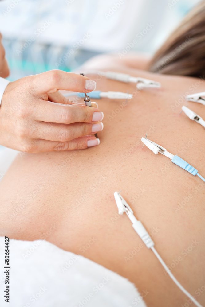 Doctora aplicando un tratamiento de electroacupuntura en la espalda de una paciente joven - obrazy, fototapety, plakaty 