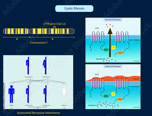 Cystic fibrosis