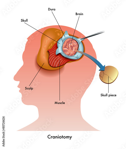 craniotomia