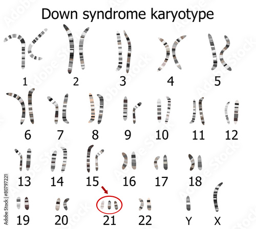 Down syndrome karyotype photo