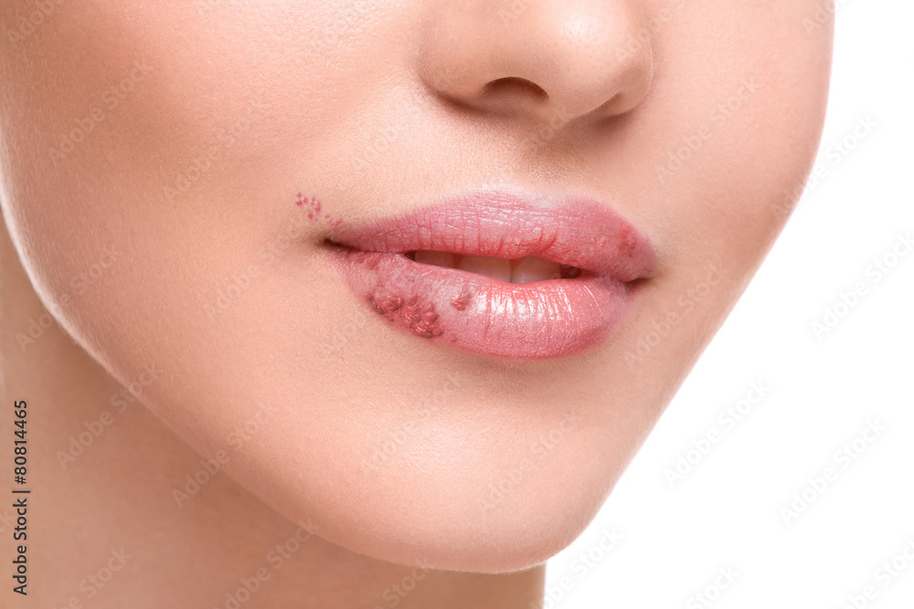 Fototapeta premium Female lips affected by herpes virus