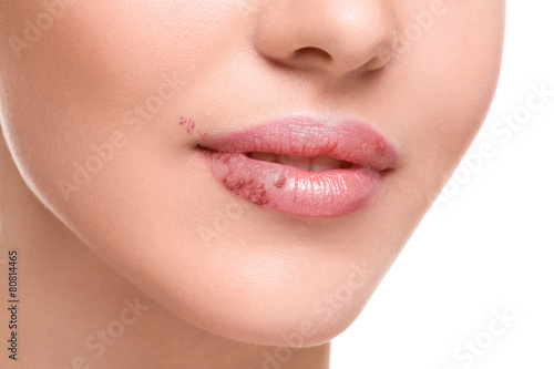 Female lips affected by herpes virus photo