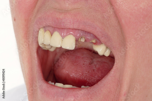 Dental, closeup of broken artificial tooth photo