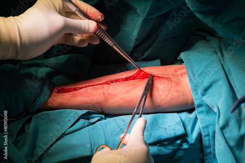 Fotografía closure sternum bone with metal wires