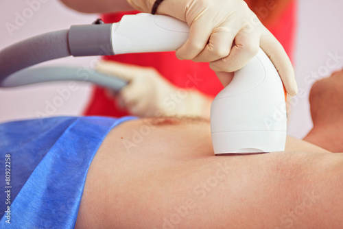 male laser epilation