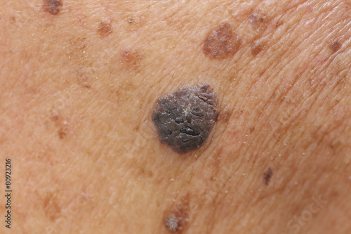 Foto suspicious mole on skin