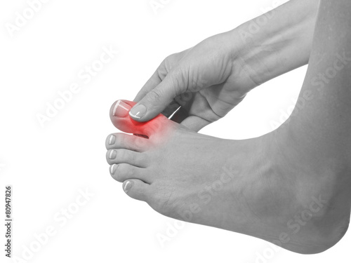 Painful and inflamed foot around the big toe area.