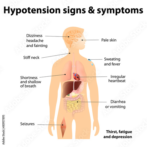 Hypotension signs & symptoms photo