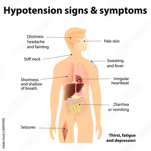 Hypotension signs & symptoms
