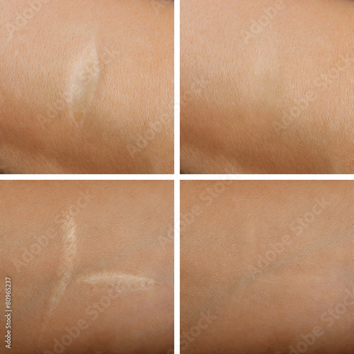 Removal of scars on the skin Fototapet