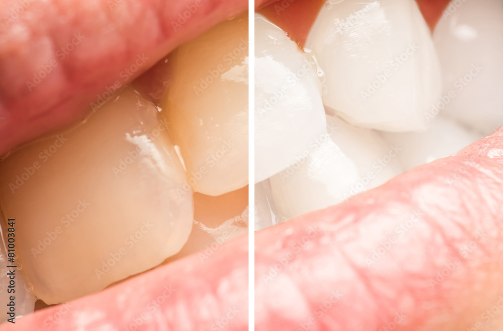 Fototapeta premium Woman Teeth Before And After Dentist Clinic Whitening Procedure