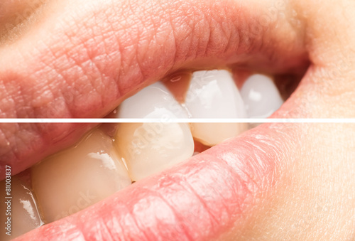 Woman Teeth Before And After Dentist Clinic Whitening Procedure