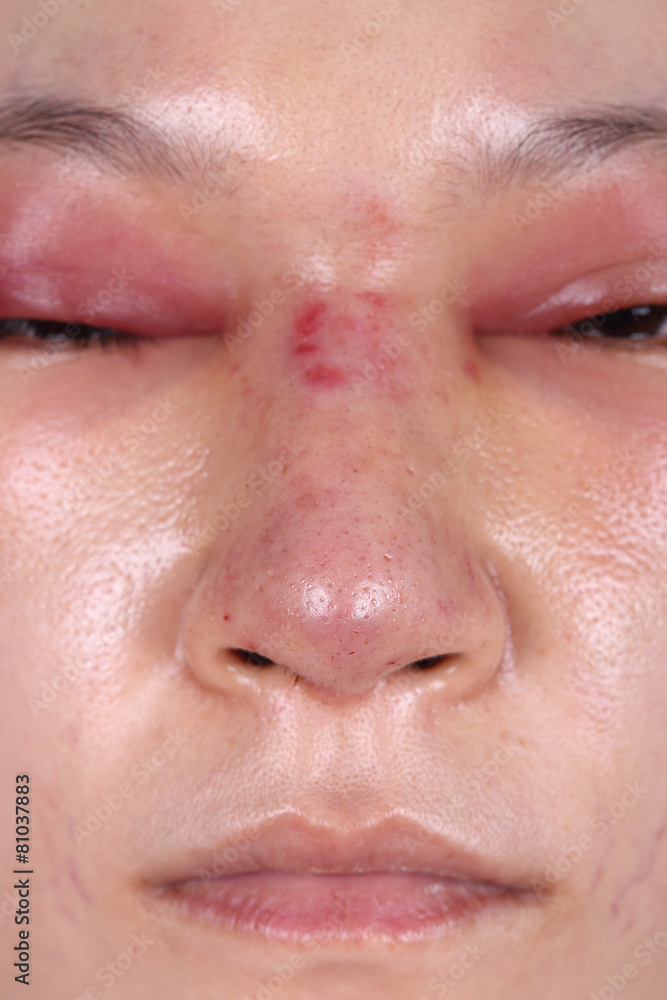 Obraz premium nose and eye swelll after nose job