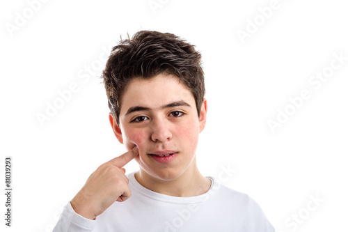 Acne Caucasian boy pointing with right index to his cheek