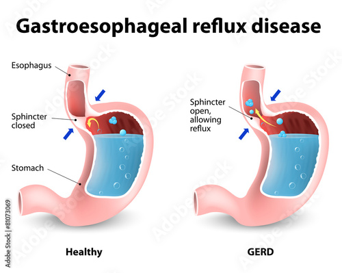Gastroesophageal Reflux Disease photo