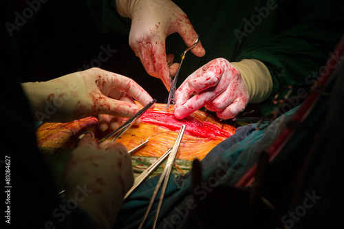closure sternum bone with metal wires