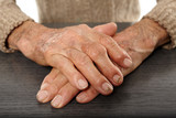 Old hands with artritis