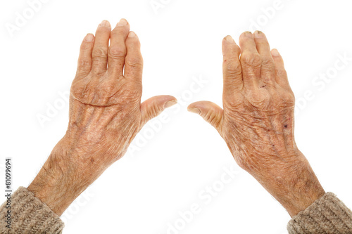 Fotografija Old hands with artritis