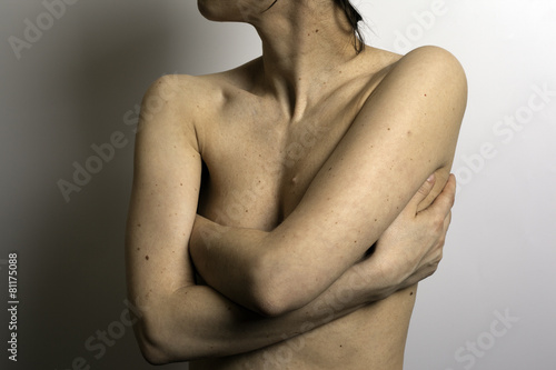 Women body with birthmarks photo