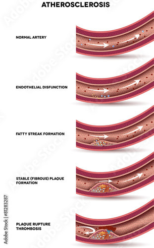 Atherosclerosis. Detailed illustration of Atherosclerosis stages
