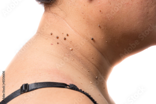 skin of a woman with moles