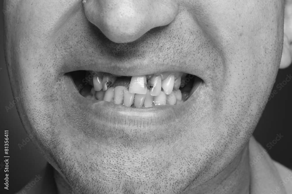 Obraz premium Bad teeth smoker