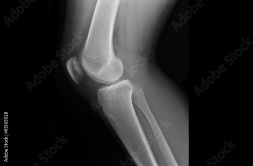 Xray Knee Joints of an Adolescent