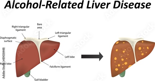 Alcohol Related Liver Disease