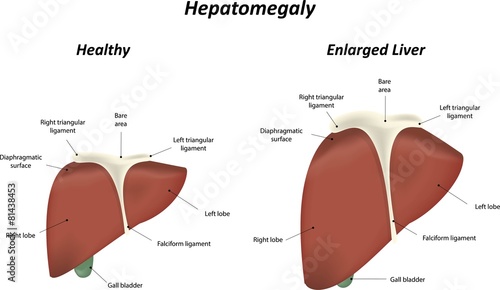 Hepatomegaly