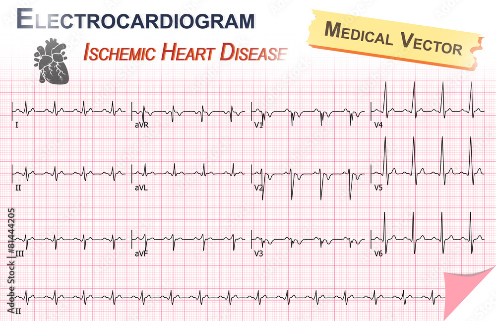 Electrocardiogram ( ECG , EKG ) of Ischemic Heart Disease
