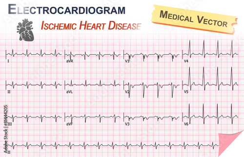 Electrocardiogram ( ECG , EKG ) of Ischemic Heart Disease