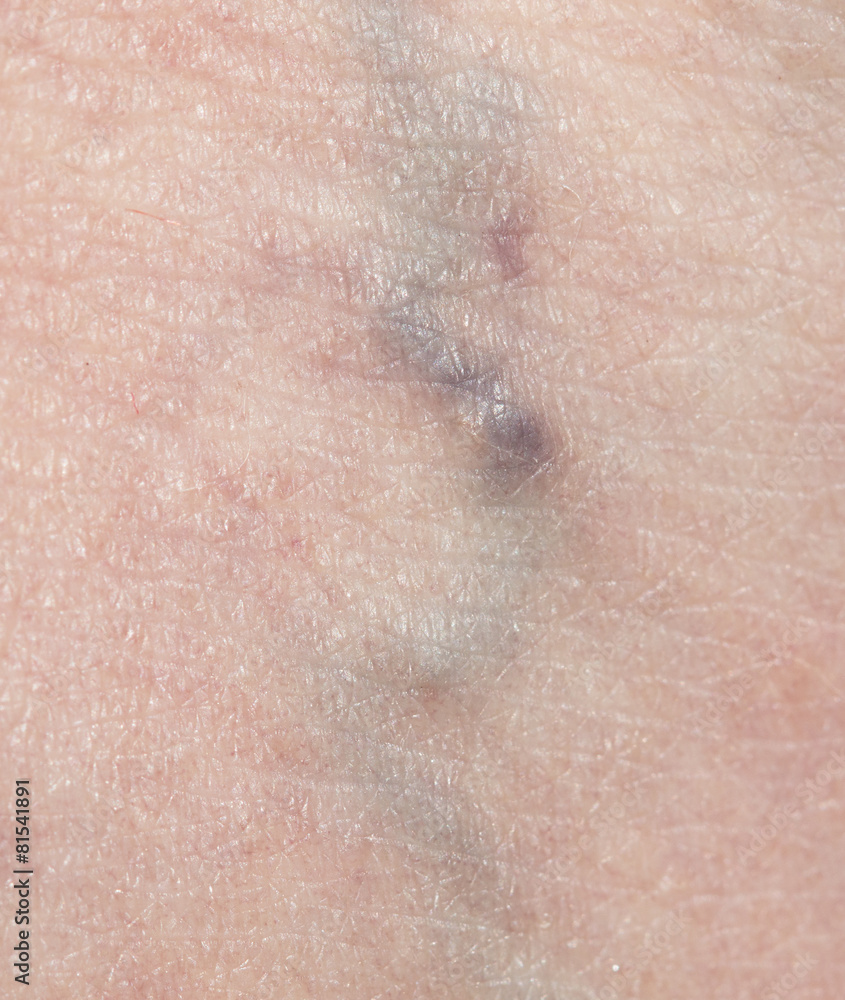 Fototapeta premium varicose veins in the leg