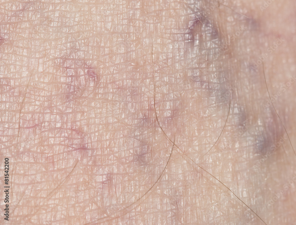 Fototapeta premium varicose veins in the leg