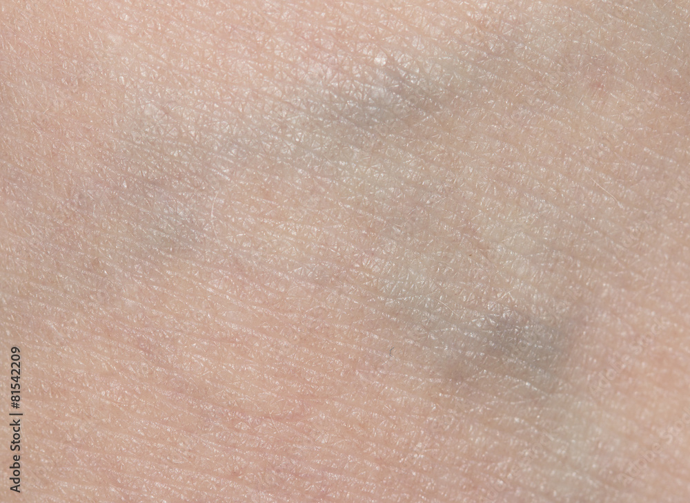 Fototapeta premium varicose veins in the leg