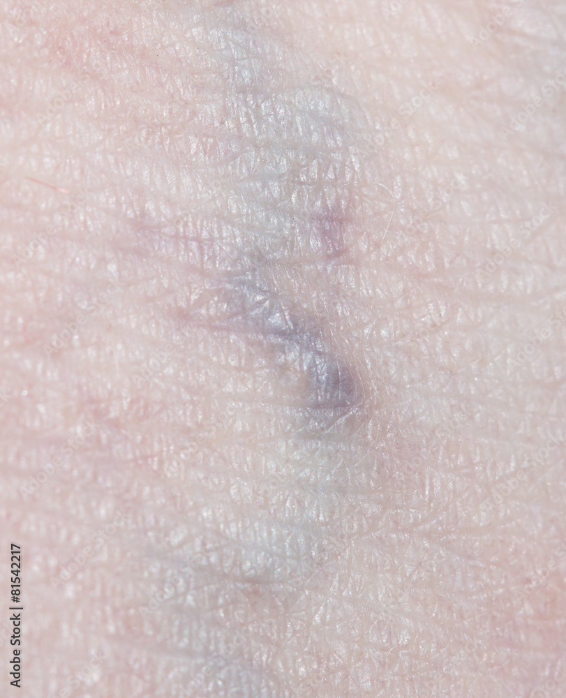 Fototapeta premium varicose veins in the leg