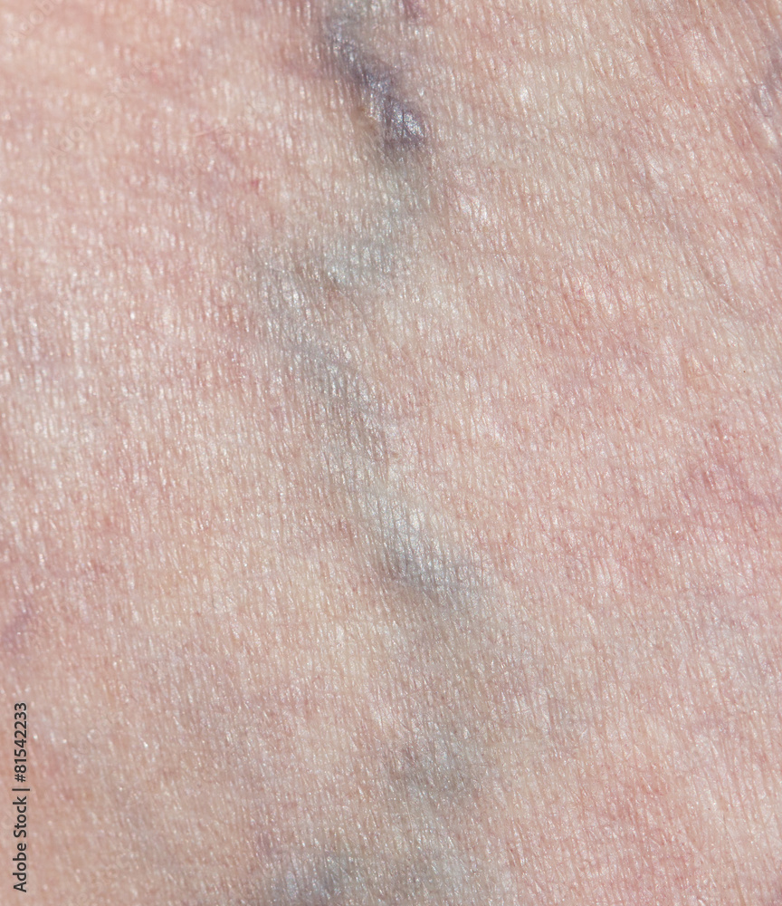 Fototapeta premium varicose veins in the leg