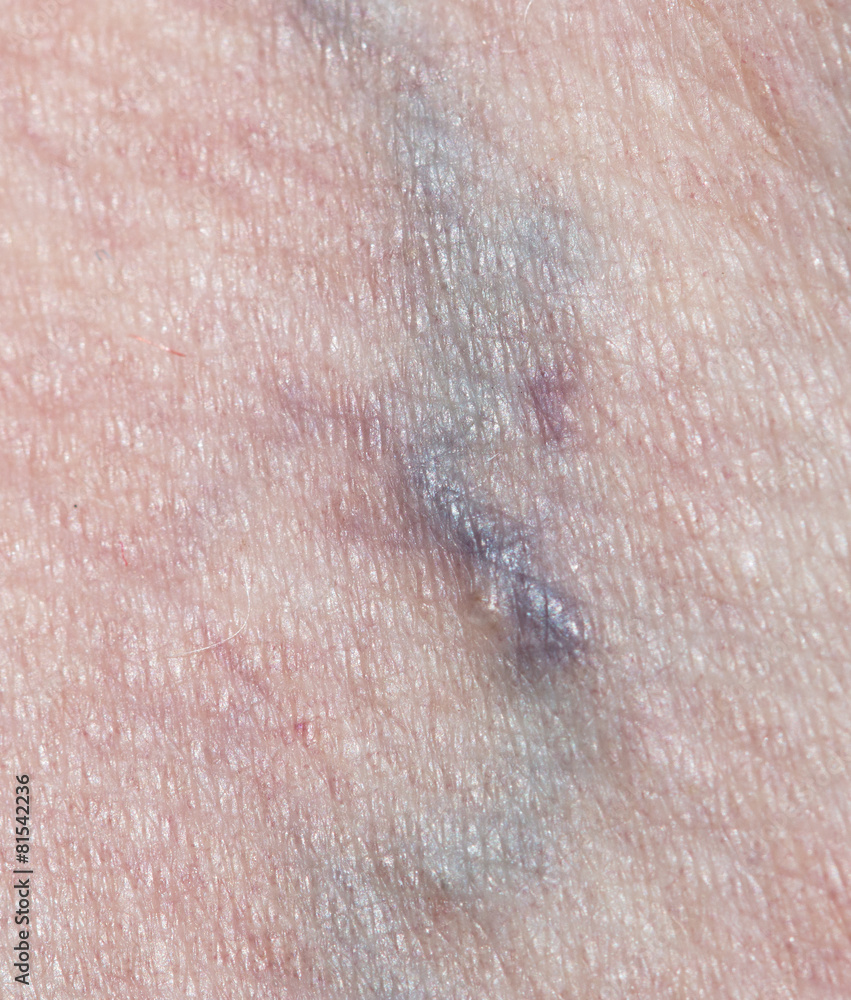 Fototapeta premium varicose veins in the leg
