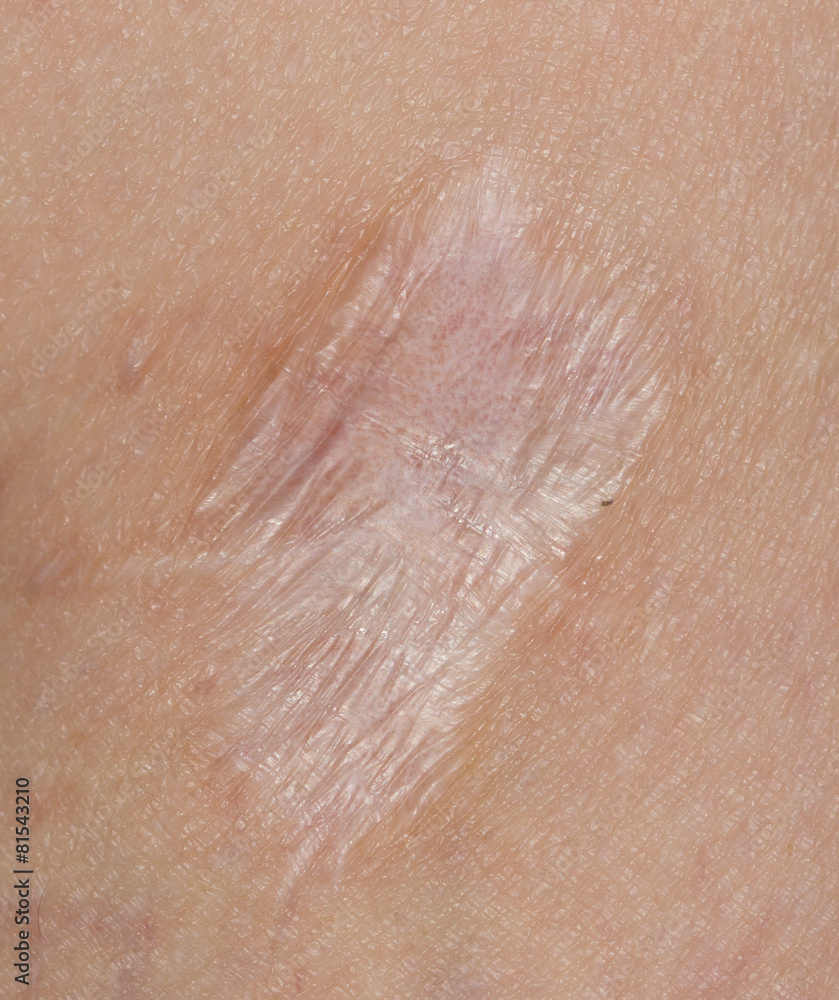 Fototapeta premium scar on his leg