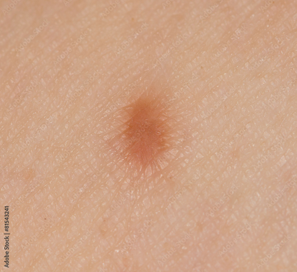 Fototapeta premium small scar on his leg